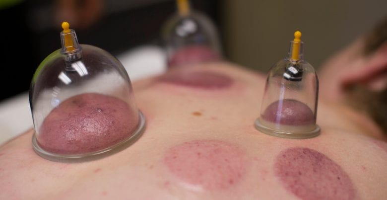 5 benefits to cupping