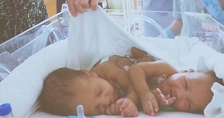 Sidra successfully separates conjoined twins