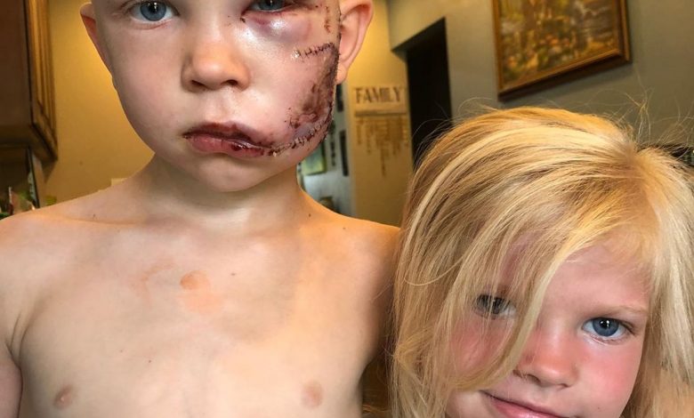A boy gets badly wounded in the face while saving his little sister from a dog attack