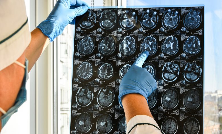 Russian scientists devise a way to treat brain cancer chemically without surgery