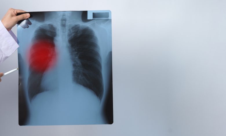 Scientists identify protein that causes lung cancer