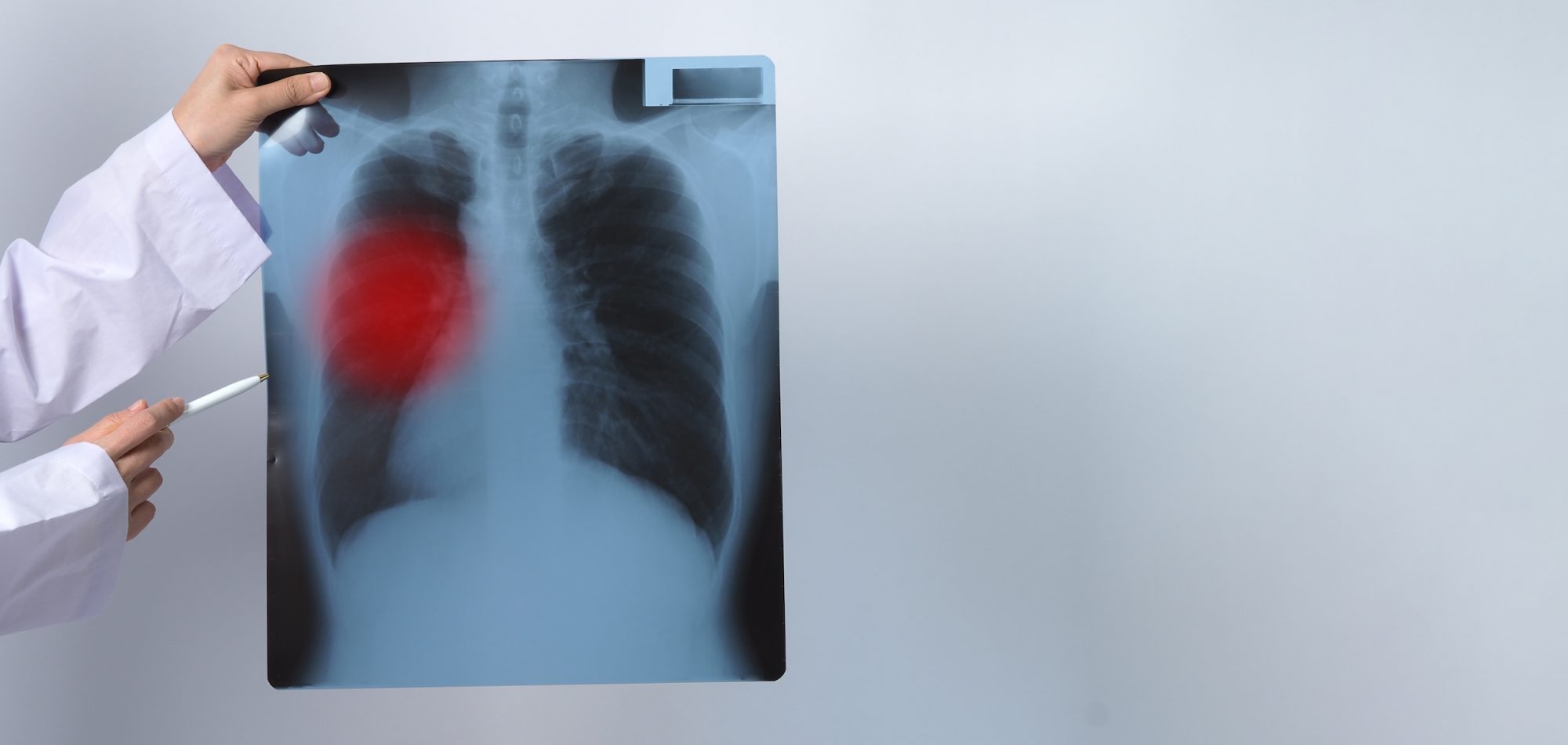 Scientists identify protein that causes lung cancer