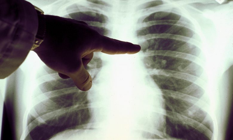 FDA Approves First Drug for Lung Cancer with Specific Mutation
