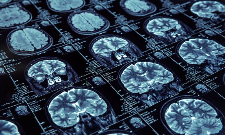Scientists discover four types of Alzheimer's