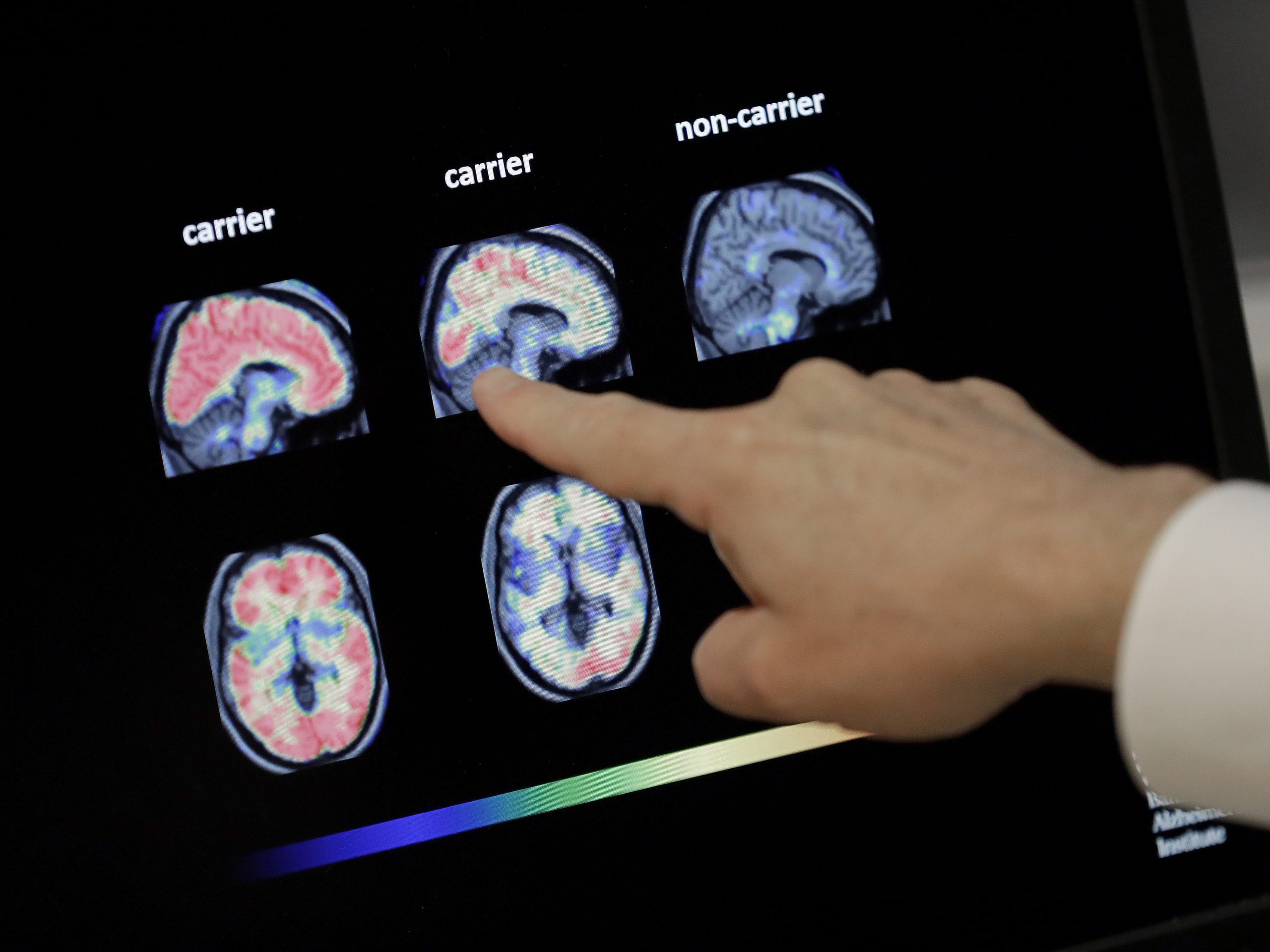 FDA Grants Accelerated Approval for Alzheimer’s Drug